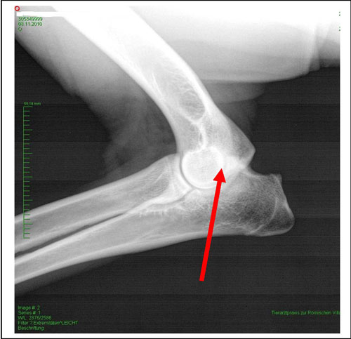 Arthrose - Röntgenbild